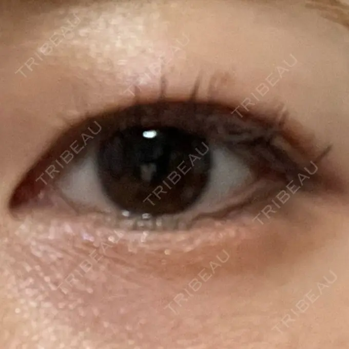 二重埋没 ネビュラクリニック 広島院 DAY 34 メイン用