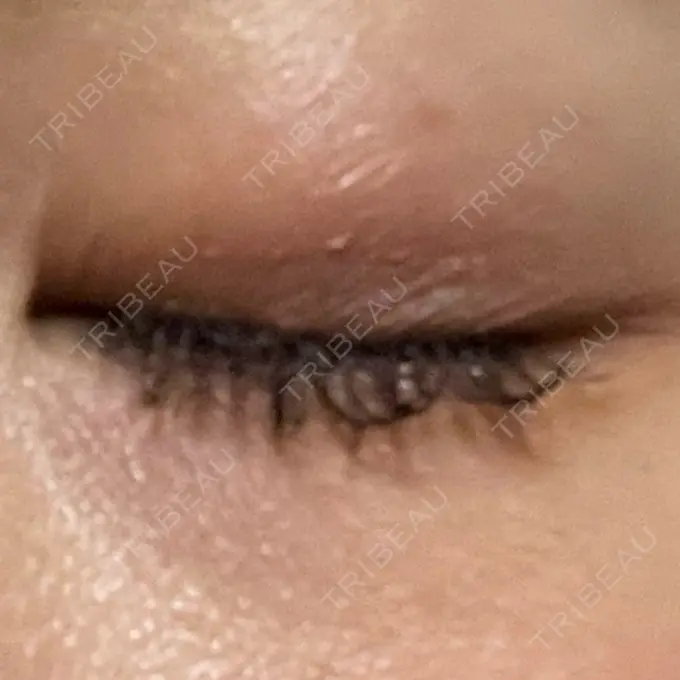 二重埋没 ネビュラクリニック 広島院 DAY 34 メイン用