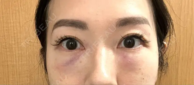 クマ治療 セオリークリニック DAY 1 メイン用