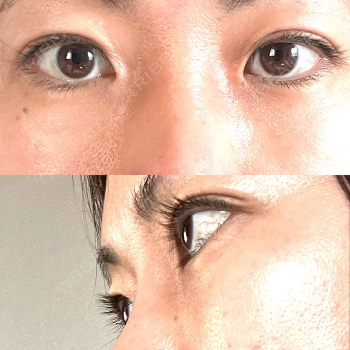 下まぶたたるみ取り セオリークリニック AFTER メイン用