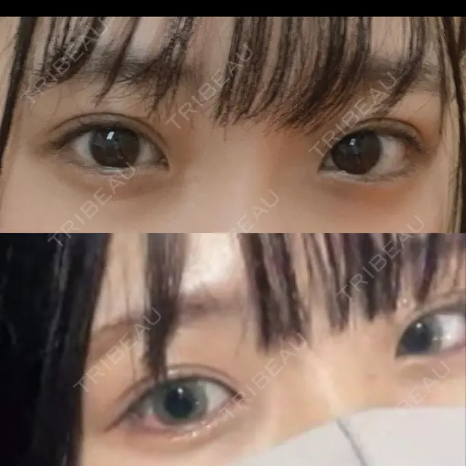 二重切開 / その他（目元） LIKI CLINIC KOBE AFTER メイン用
