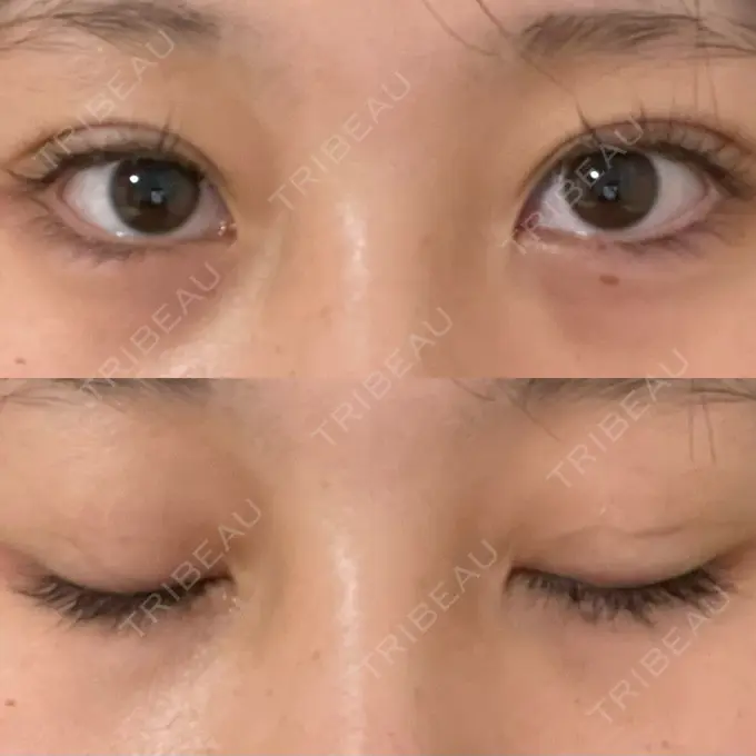 二重埋没 十仁美容整形 DAY 7 メイン用