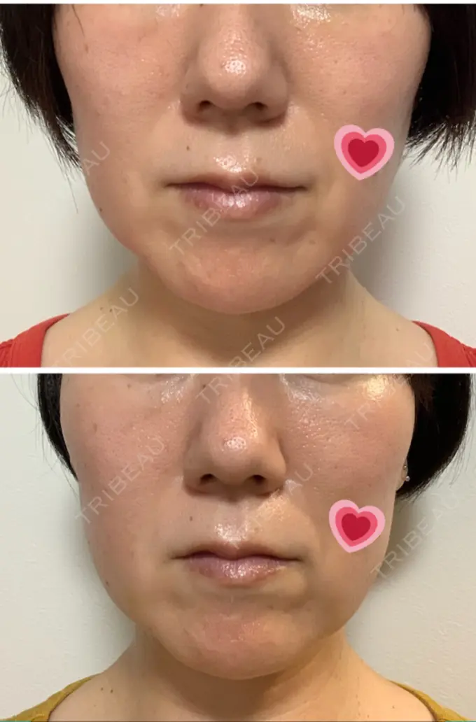 糸リフト 吉井クリニック DAY 10 メイン用