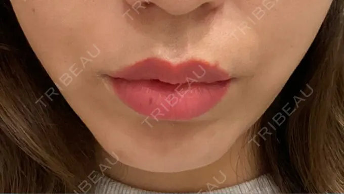 ボトックス（人中） veary clinic AFTER メイン用