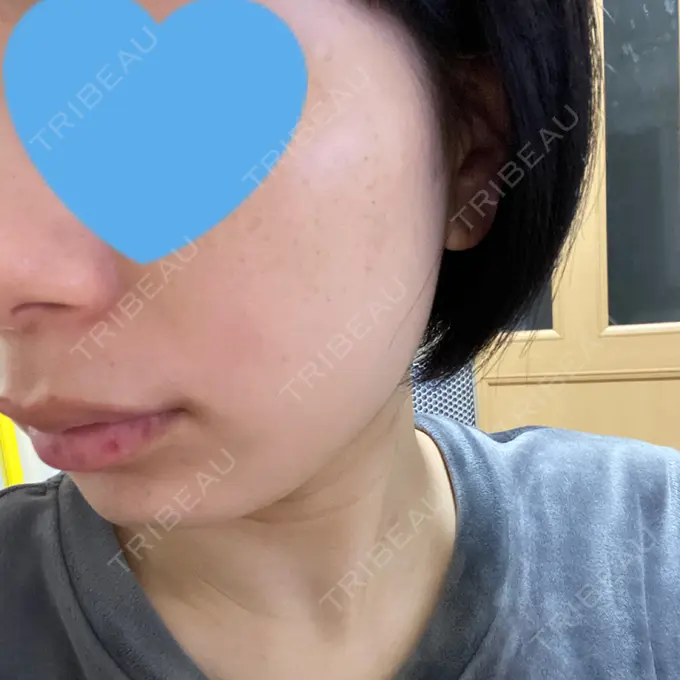 フォトRF Rosa Beauty Clinic DAY 6 メイン用