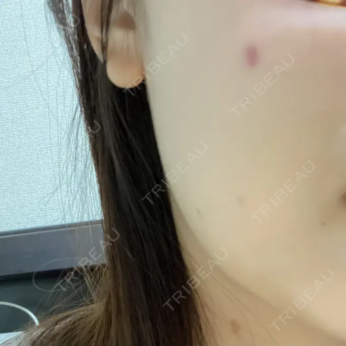 ほくろ・いぼ切除（肌） 吉祥寺アイビークリニック DAY 163 メイン用