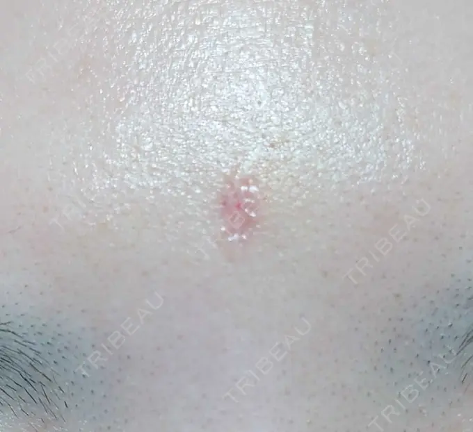 傷跡修正 / 傷跡修正 TETSU形成・美容クリニック DAY 9 メイン用