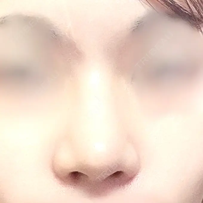 軟骨移植 / 骨切幅寄せ / 鼻中隔延長（非切開） エイト美容外科 DAY 151 メイン用