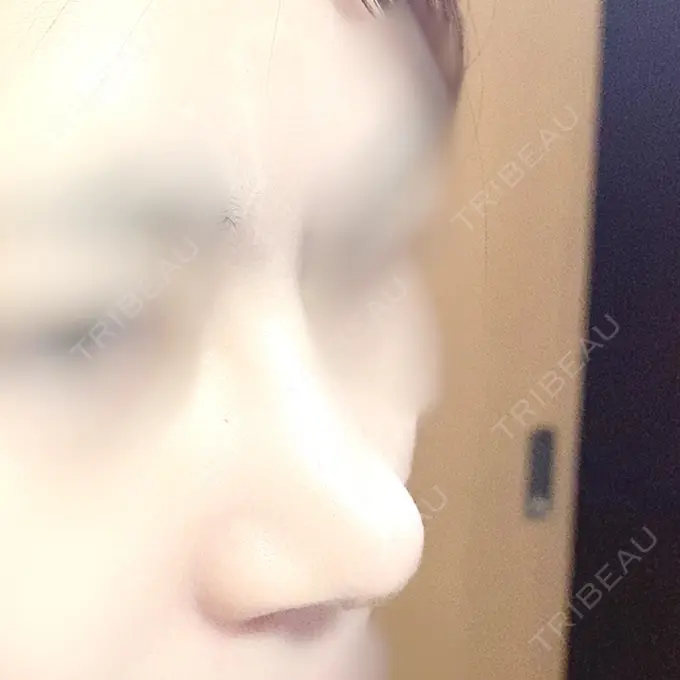 軟骨移植 / 骨切幅寄せ / 鼻中隔延長（非切開） エイト美容外科 DAY 151 メイン用