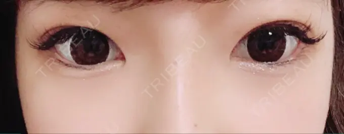 二重埋没 品川スキンクリニック広島院 AFTER メイン用