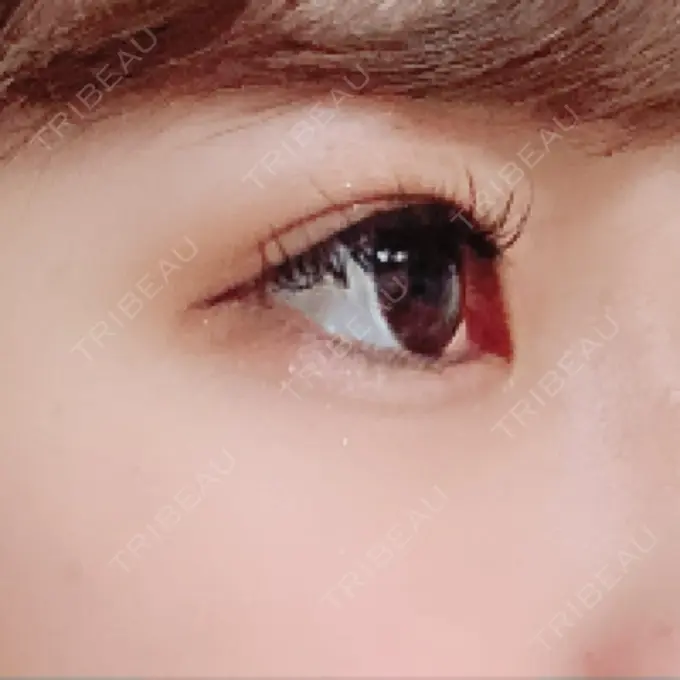 二重埋没 品川スキンクリニック広島院 DAY 331 メイン用