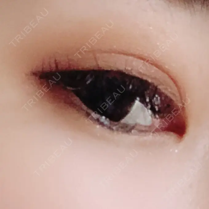 二重埋没 品川スキンクリニック広島院 DAY 331 メイン用