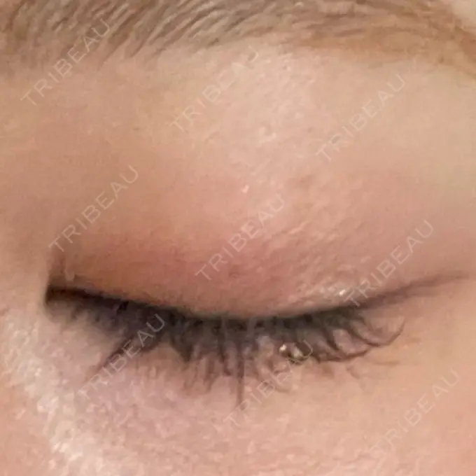 二重埋没 ネビュラクリニック 広島院 DAY 41 メイン用