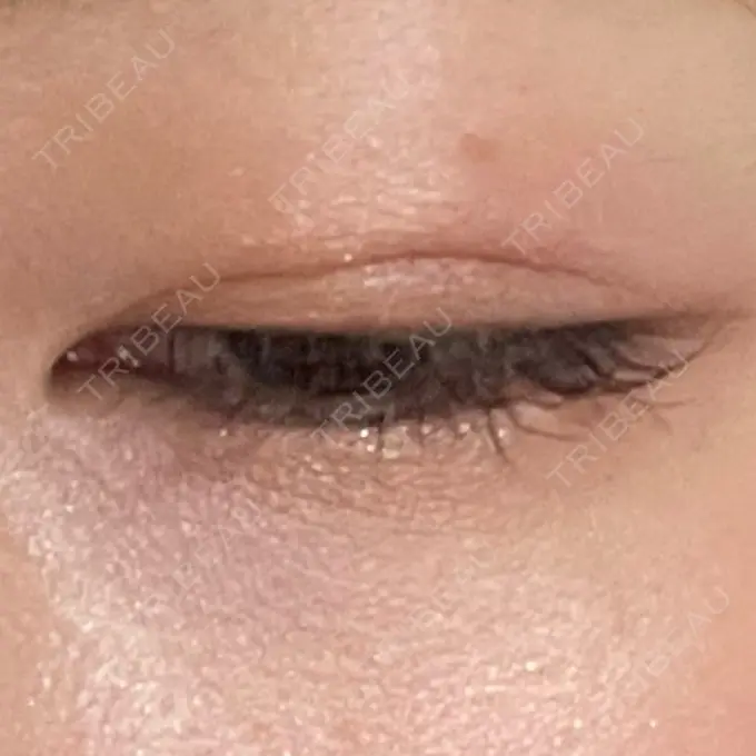 二重埋没 ネビュラクリニック 広島院 DAY 41 メイン用