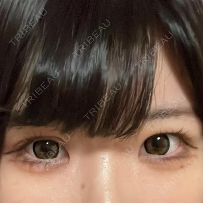 目頭切開 聖心美容クリニック 名古屋院 AFTER メイン用