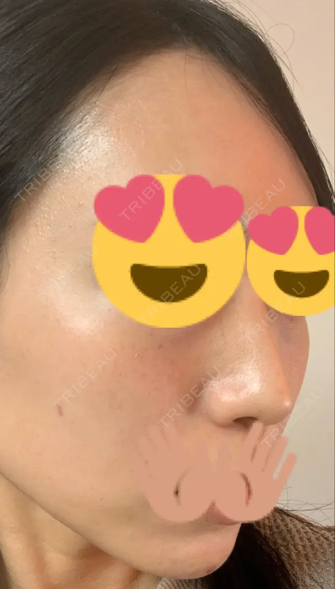 ほくろ・いぼ切除（肌） / 高濃度ビタミンC点滴 TCB東京中央美容外科 広島院 DAY 49 メイン用