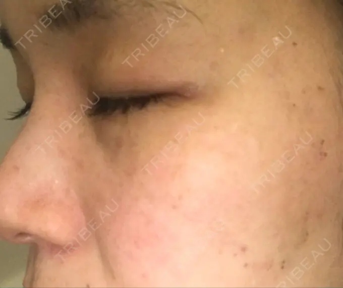 シミ取りレーザー 仁愛クリニック DAY 9 メイン用