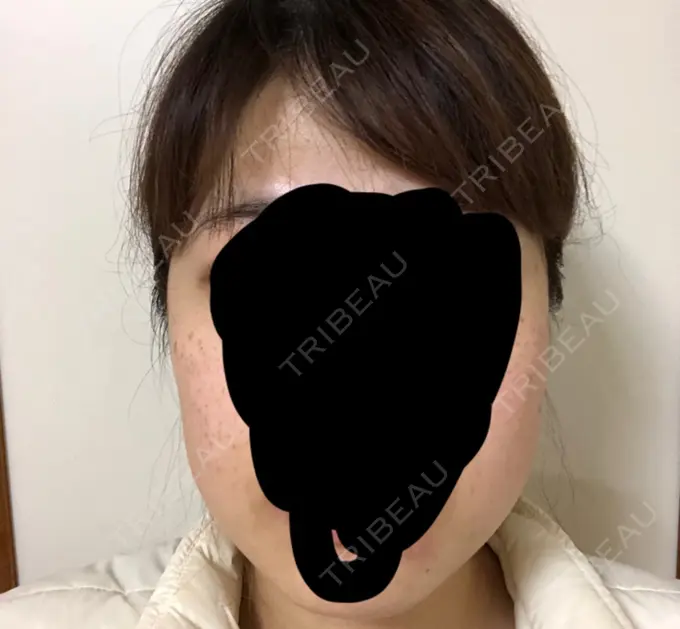 ボトックス（エラ・小顔） 湘南美容クリニック 名古屋栄院 DAY 8 メイン用