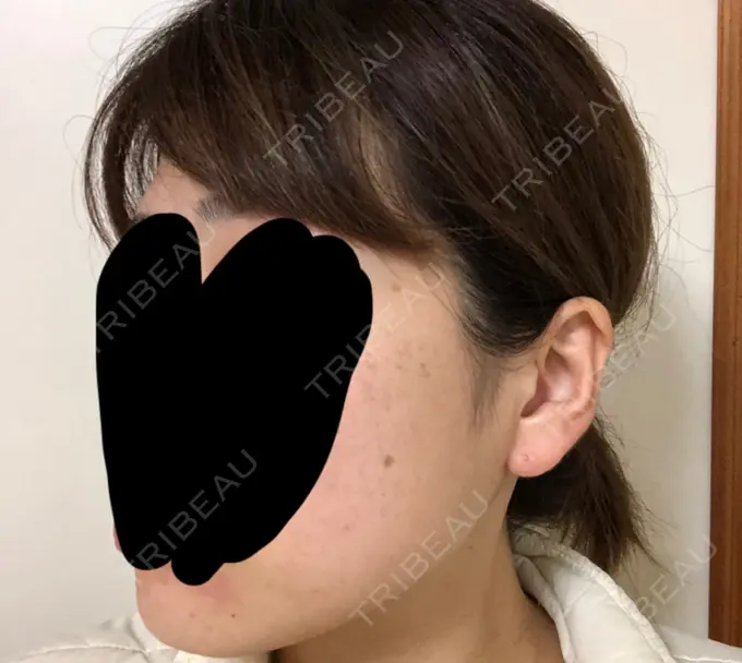 ボトックス（エラ・小顔） 湘南美容クリニック 名古屋栄院 DAY 8 メイン用