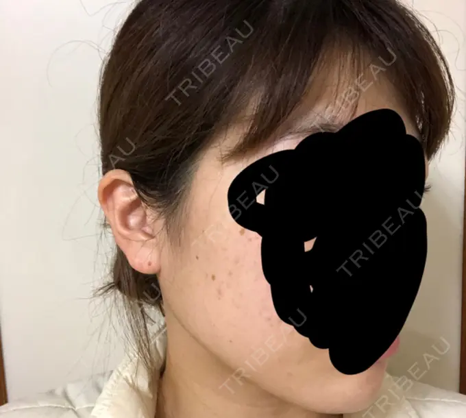 ボトックス（エラ・小顔） 湘南美容クリニック 名古屋栄院 DAY 8 メイン用