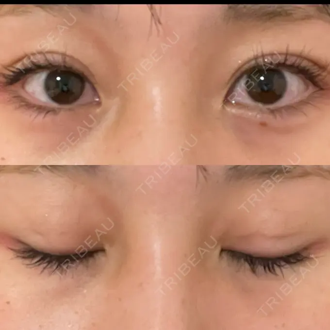 二重埋没 十仁美容整形 DAY 14 メイン用