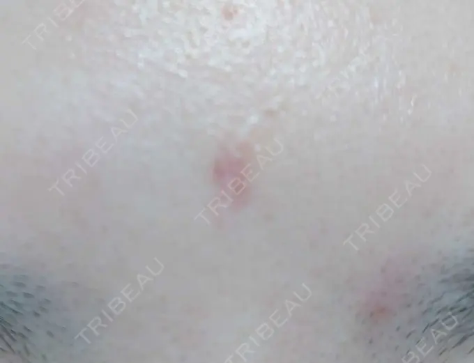 傷跡修正 / 傷跡修正 TETSU形成・美容クリニック DAY 13 メイン用