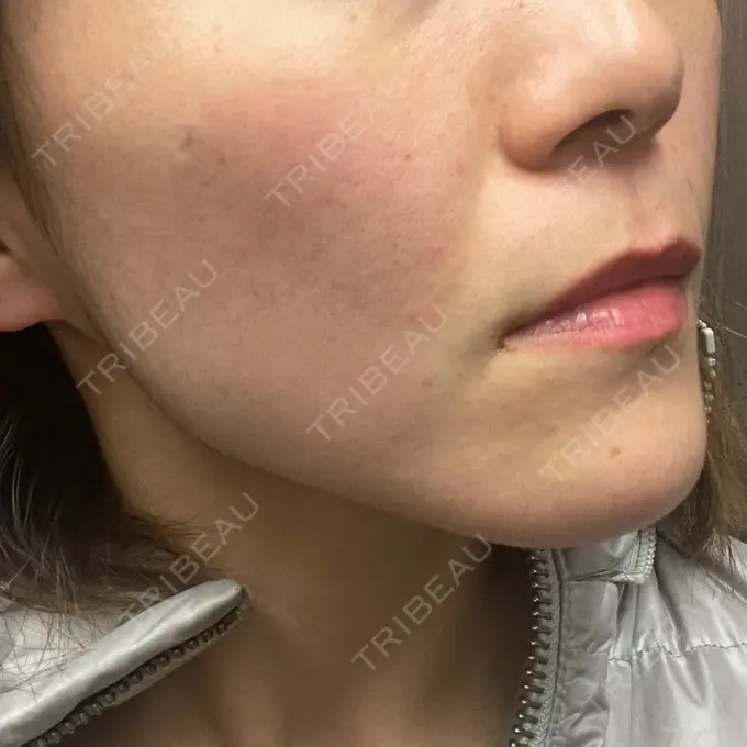 ボトックス（エラ・小顔） TCB東京中央美容外科 銀座二丁目院 DAY 1 メイン用