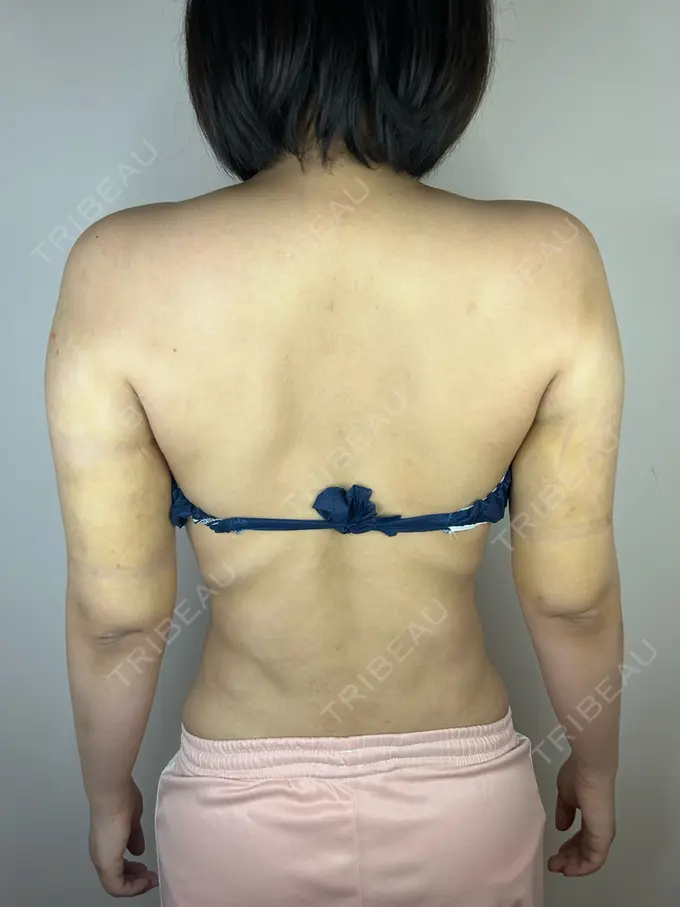 脂肪吸引（二の腕） GAYA body design clinic DAY 10 メイン用