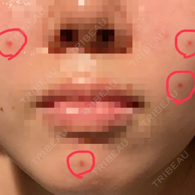 ほくろ・いぼ切除（肌） LIKI CLINIC KOBE DAY 13 メイン用