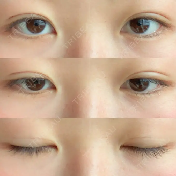 二重埋没 湘南美容クリニック 長野院 AFTER メイン用