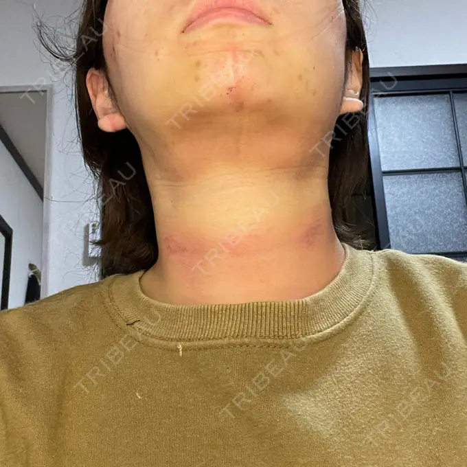 脂肪吸引（顔） / 下まぶたたるみ取り / メーラーファット除去 WOM CLINIC GINZA （ワム クリニック ギンザ） DAY 1 メイン用