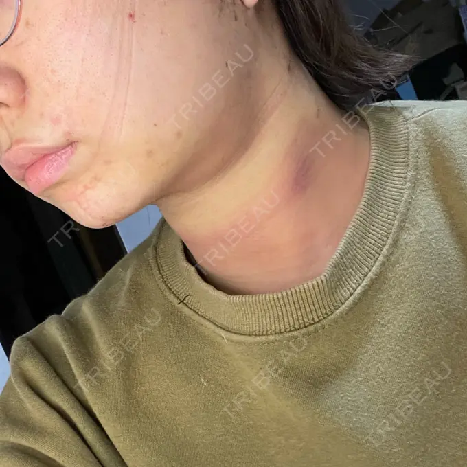 脂肪吸引（顔） / 下まぶたたるみ取り / メーラーファット除去 WOM CLINIC GINZA （ワム クリニック ギンザ） DAY 1 メイン用