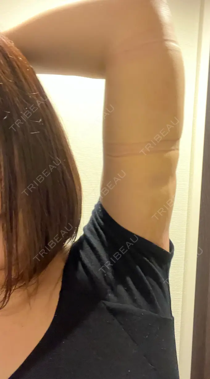 脂肪吸引（二の腕） GAYA body design clinic DAY 12 メイン用