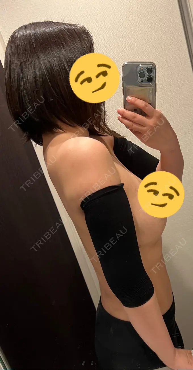 脂肪吸引（二の腕） GAYA body design clinic DAY 12 メイン用