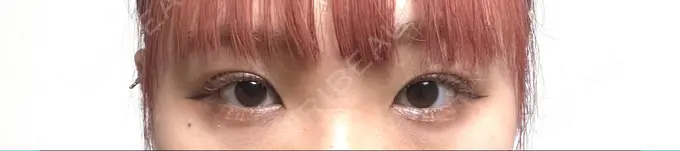 二重埋没 グランメドクリニック茨木 DAY 4 メイン用