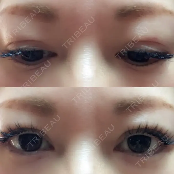 二重埋没 湘南美容クリニック 東京蒲田院 DAY 18 メイン用