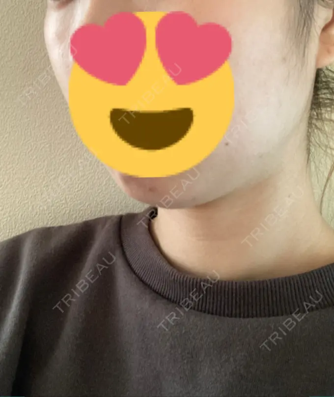 ボトックス（エラ・小顔） TCB東京中央美容外科 名古屋栄院 DAY 10 メイン用