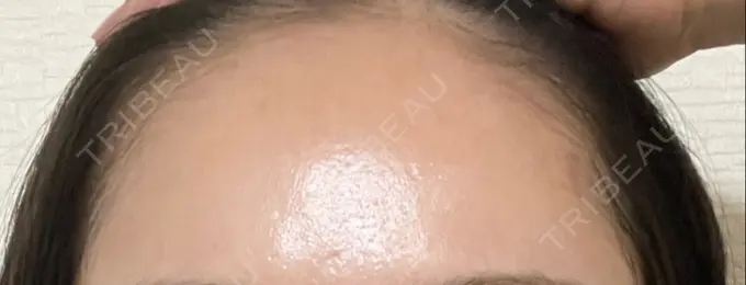 ピーリング（ニキビ・毛穴） 大塚美容形成外科・歯科 大塚本院 DAY 0 メイン用