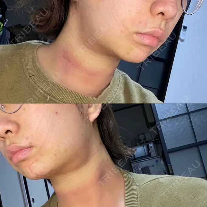 脂肪吸引（顔） / 下まぶたたるみ取り / メーラーファット除去 WOM CLINIC GINZA （ワム クリニック ギンザ） DAY 1 メイン用