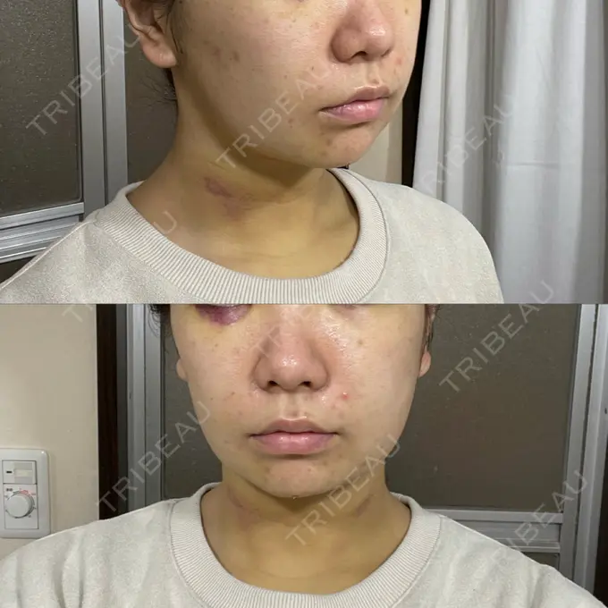 脂肪吸引（顔） / 下まぶたたるみ取り / メーラーファット除去 WOM CLINIC GINZA （ワム クリニック ギンザ） DAY 3 メイン用