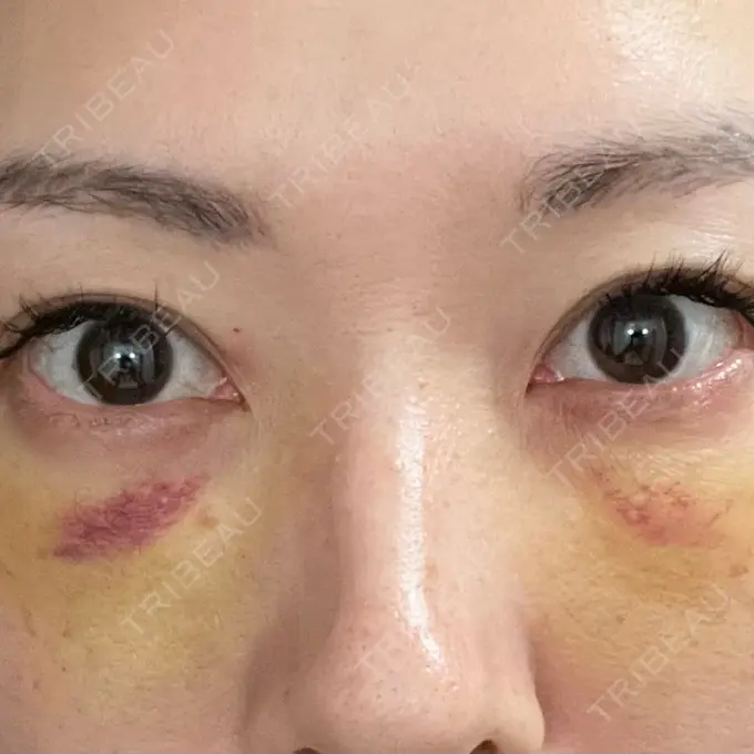 クマ治療 セオリークリニック DAY 7 メイン用