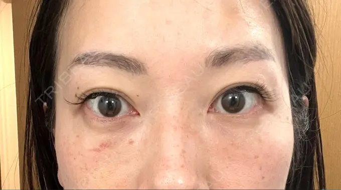 クマ治療 セオリークリニック DAY 13 メイン用