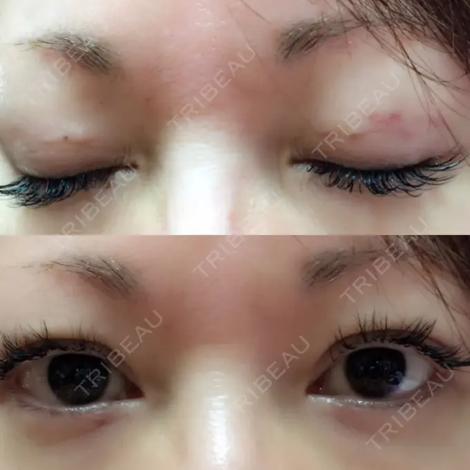 二重埋没 湘南美容クリニック 東京蒲田院 DAY 18 メイン用