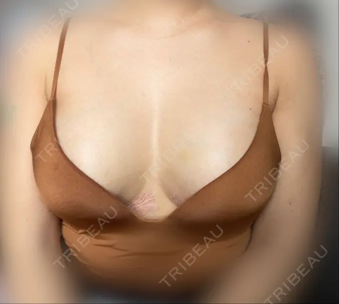 豊胸（シリコンバッグ） MYCLI【マイクリ】東京・恵比寿院 DAY 6 メイン用