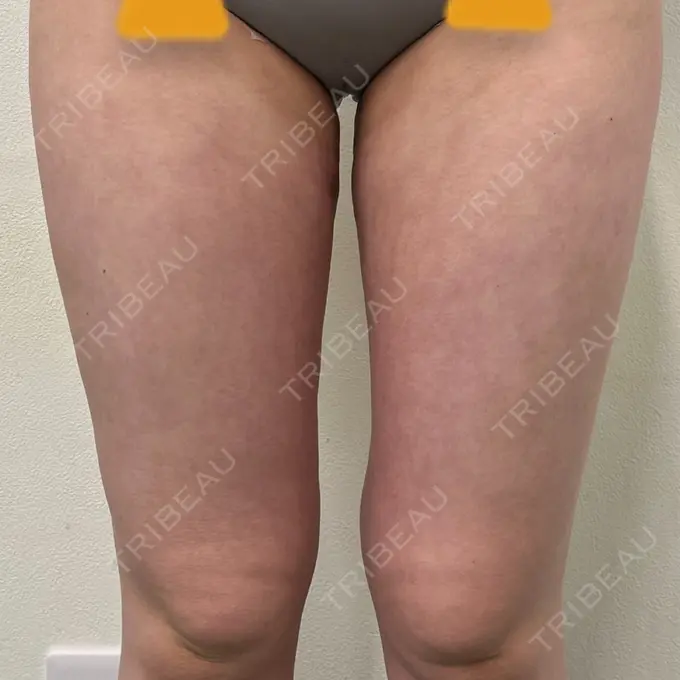 脂肪吸引（脚） Mods Clinic（モッズクリニック） 名古屋院 DAY 28 メイン用