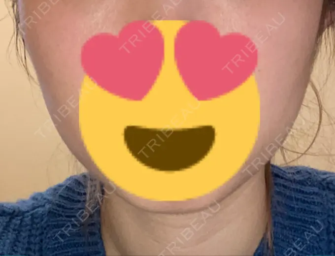 ボトックス（エラ・小顔） TCB東京中央美容外科 名古屋栄院 DAY 11 メイン用