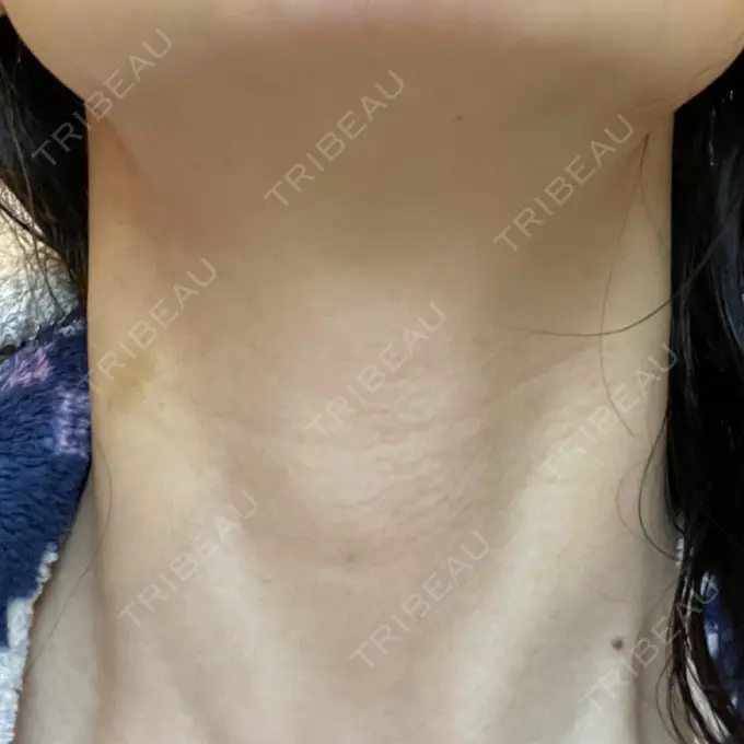 ヒアルロン酸注入（首） / PRP皮膚再生療法 ももスキンケアクリニック DAY 5 メイン用