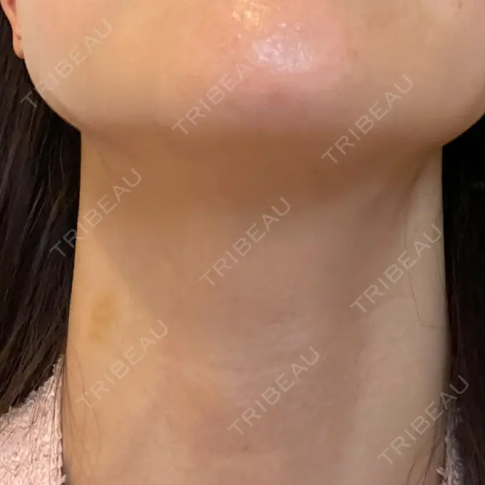 ヒアルロン酸注入（首） / PRP皮膚再生療法 ももスキンケアクリニック DAY 6 メイン用