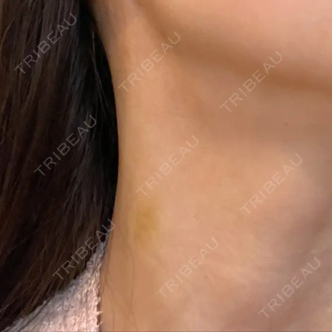 ヒアルロン酸注入（首） / PRP皮膚再生療法 ももスキンケアクリニック DAY 6 メイン用