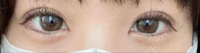 二重埋没 yuzawa clinic AFTER メイン用